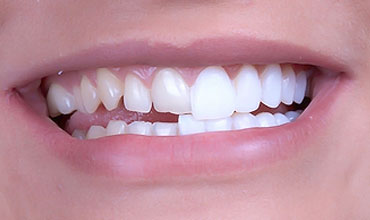 Veneers
