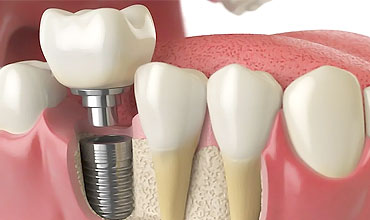 dental-implants