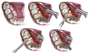 dentoalveolar-surgery