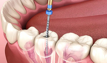 root-canal-treatment