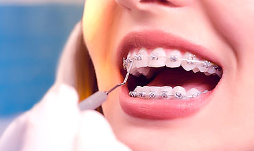 teeth-alignment